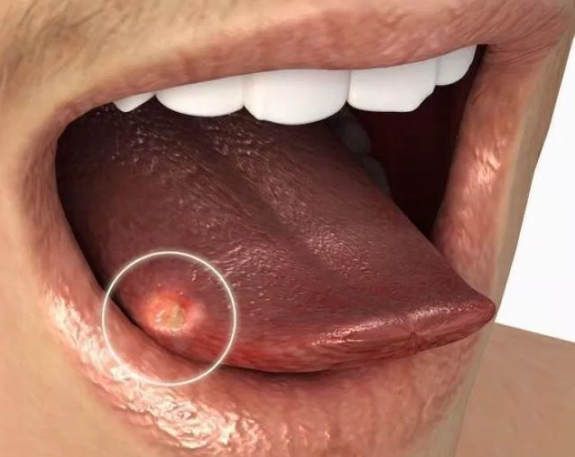 Một vết loét nhỏ trên lưỡi cũng có thể là dấu hiệu của ung thư lưỡi (Ảnh: Internet)