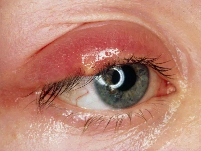 Ung thư mắt là một dạng ung thư hiếm gặp.  (Hình: Internet)