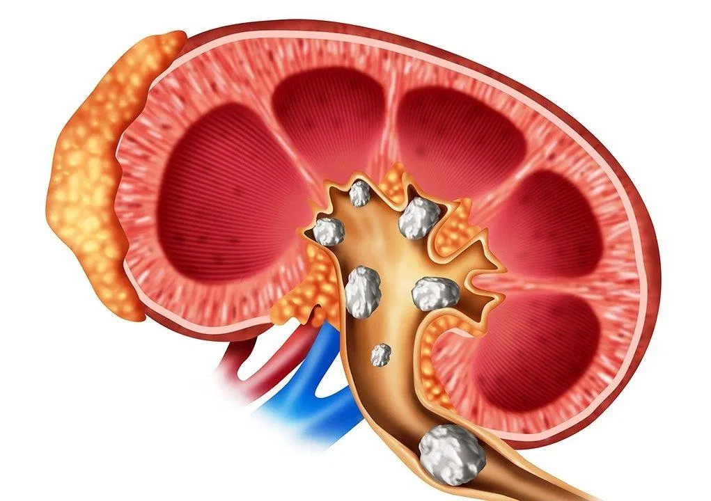 Bệnh sỏi thận không phải là hiếm gặp (Nguồn: Internet). Bệnh sỏi thận không phải là hiếm gặp (Nguồn: Internet).