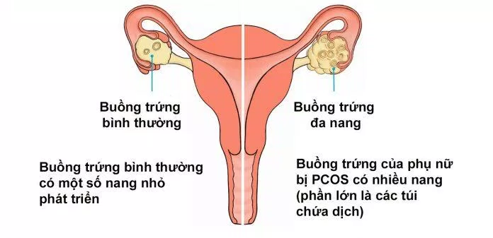 Hội chứng buồng trứng đa nang (Nguồn: Internet). Hội chứng buồng trứng đa nang (Nguồn: Internet).