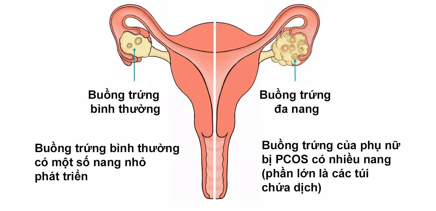 Hội chứng buồng trứng đa nang (Nguồn: Internet).