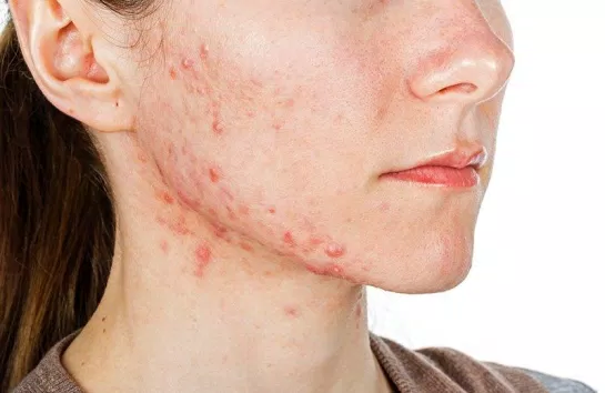 Portrait of young girl with skin problem