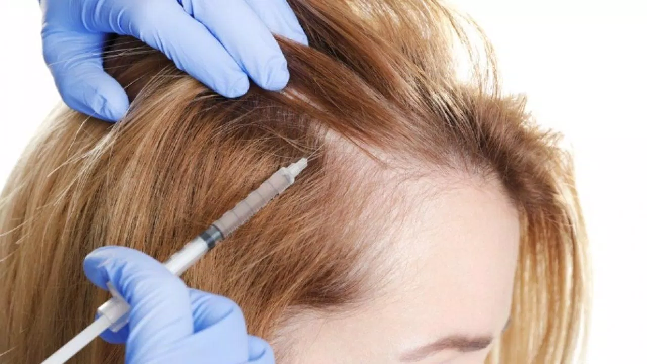 Chữa rụng tóc bằng Botox hoặc PRP đang là xu hướng