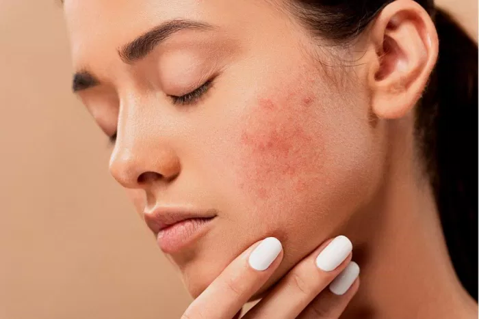 Skincare trị mụn ẩn hiệu quả chỉ trong 6 bước