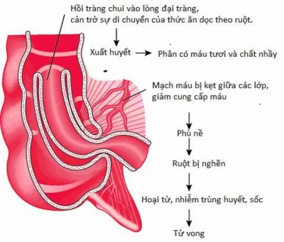 Hiện tượng lồng ruột thường gặp ở trẻ nhỏ (Nguồn: Internet) Hiện tượng lồng ruột thường gặp ở trẻ nhỏ (Nguồn: Internet)