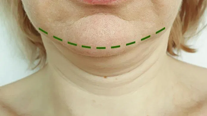 Cách khắc phục mặt béo, cằm nọng hiệu quả (Nguồn: internet)