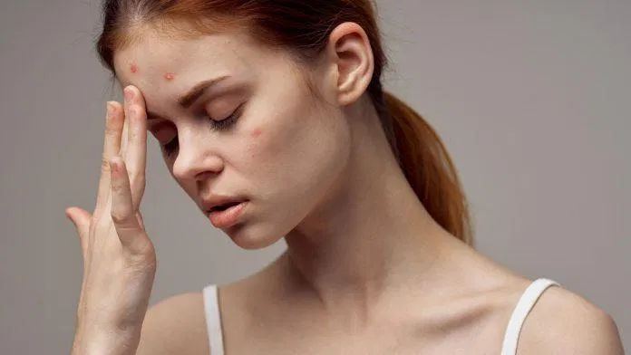 Vi khuẩn P.acnes cũng là yếu tố làm da nổi mụn (Nguồn: internet)