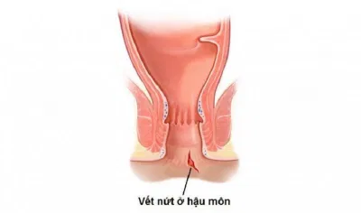 Nứt kẽ hậu môn táo bón kéo dài (Nguồn: Internet) Nứt kẽ hậu môn táo bón kéo dài (Nguồn: Internet)