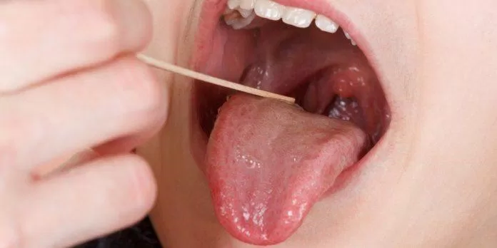 Ung thư hầu họng cũng là một bệnh ung thư nằm trên lưỡi (đáy lưỡi) (Ảnh: Internet)