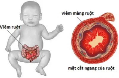 Viêm ruột hoại tử (Nguồn: Internet) Viêm ruột hoại tử (Nguồn: Internet)