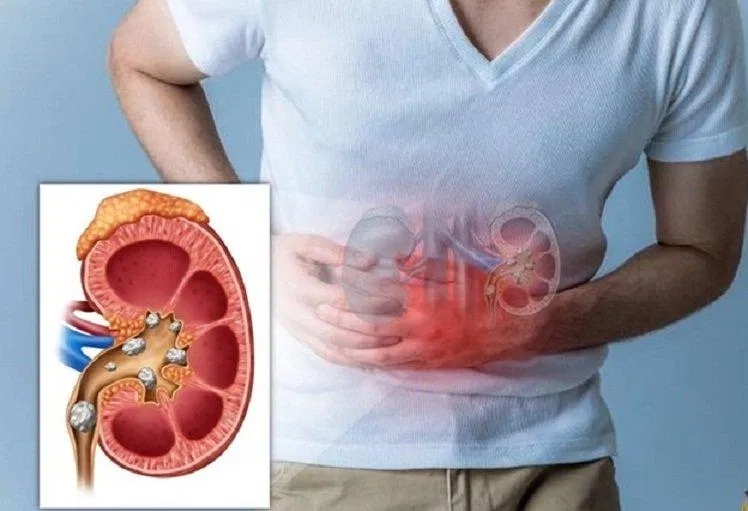 Sỏi đường tiết niệu có thể gây đau lưng (Nguồn: Internet) Sỏi đường tiết niệu có thể gây đau lưng (Nguồn: Internet)