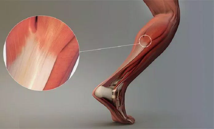 Gân là bộ phận kết nối cơ với xương (Ảnh: Internet).