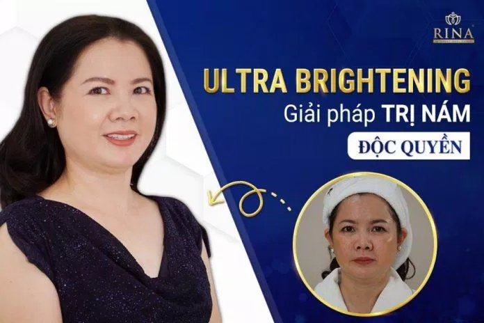 Viện thẩm mỹ RINA ứng dụng công nghệ Ultra Brighteningn điều trị nám độc quyền (Nguồn: Viện thẩm mỹ RINA)