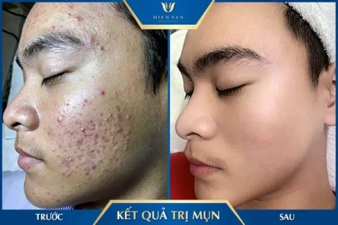 Hình ảnh trước và sau khi điều trị tại Hiền Vân spa (Nguồn: Hiền Vân Spa)