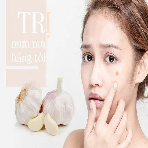 Tỏi trị mụn rất tốt (Nguồn: Internet)