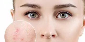 Mụn trứng cá rất dễ bắt gặp ở mọi người, đặc biệt trong giai đoạn tuổi dậy thì (nguồn: internet)