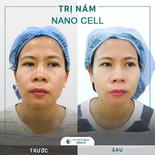 Đông Á áp dụng công nghệ Nano Cell điều trị nám da (Nguồn: Đông Á)