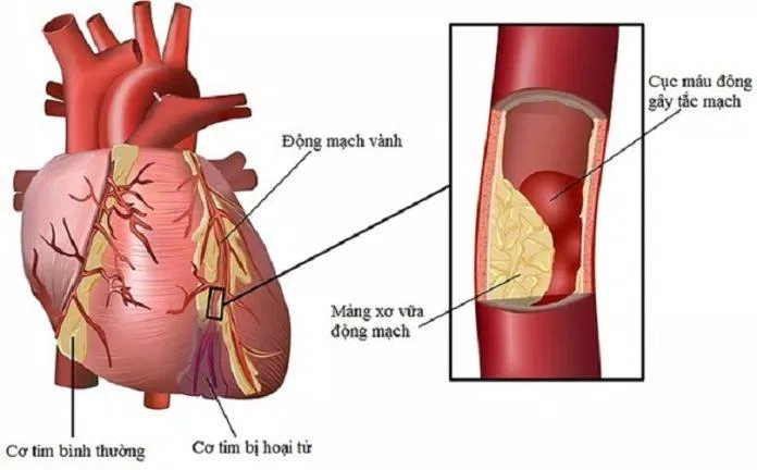 Bệnh động mạch vành có thể gây đau ngực (Ảnh: Internet).