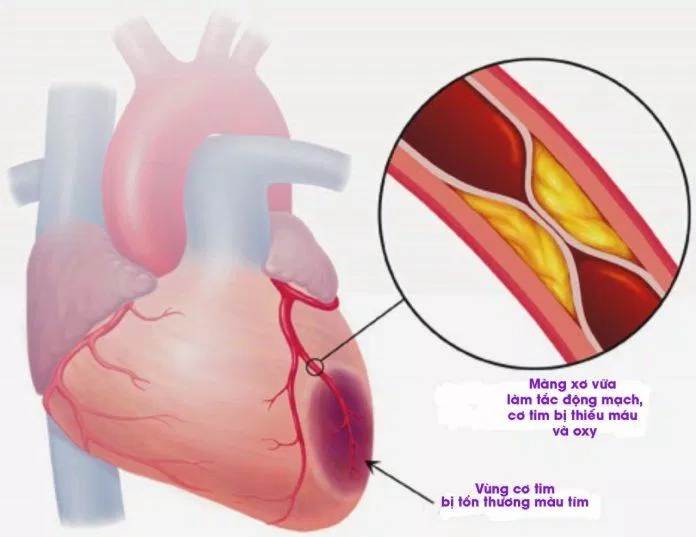 Đau tức ngực do tắc mạch vành trong nhồi máu cơ tim (Nguồn: Internet).