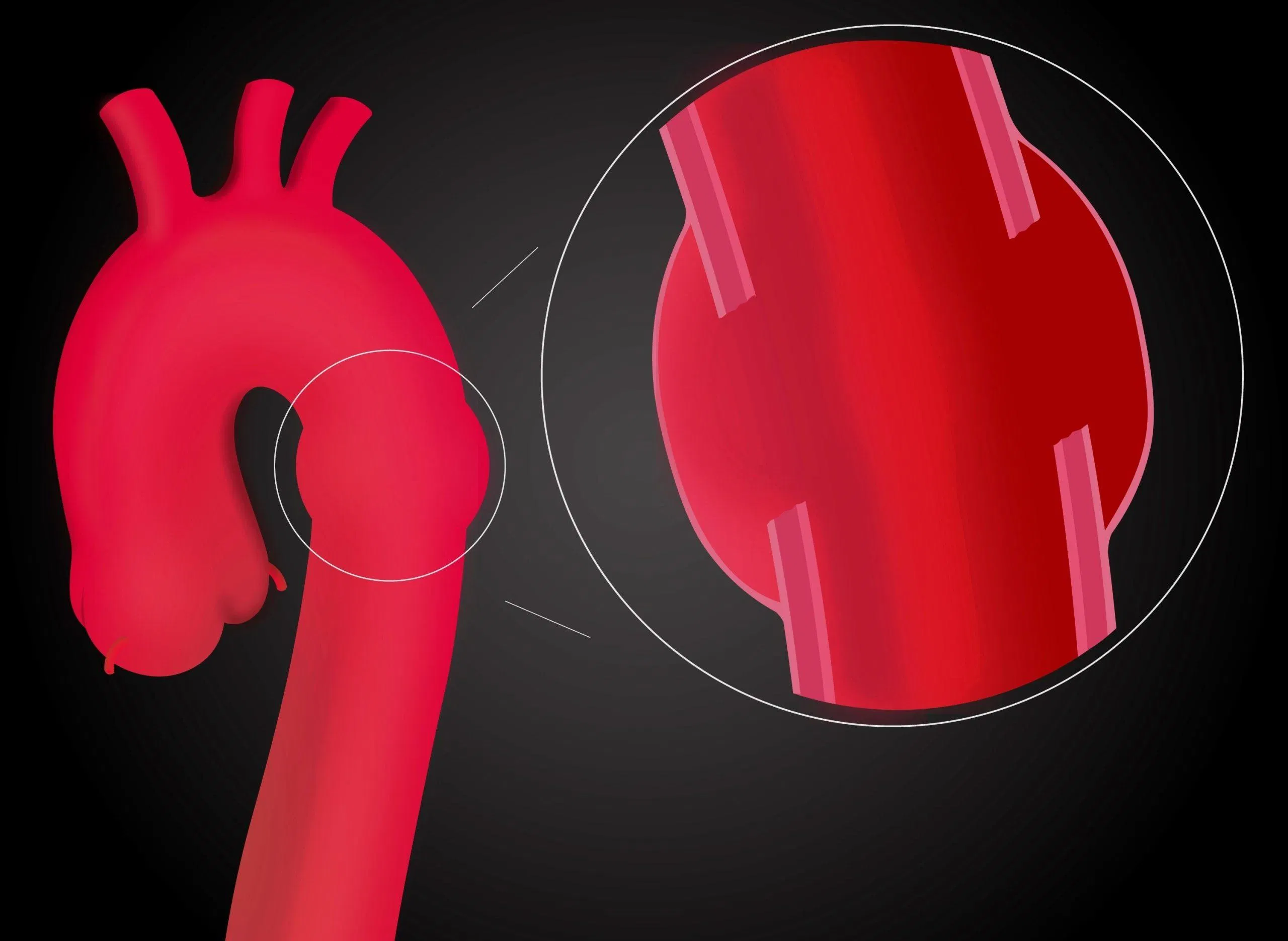 Đau ngực do phình động mạch chủ ngực (Nguồn: Internet). Đau ngực do phình động mạch chủ ngực (Nguồn: Internet).