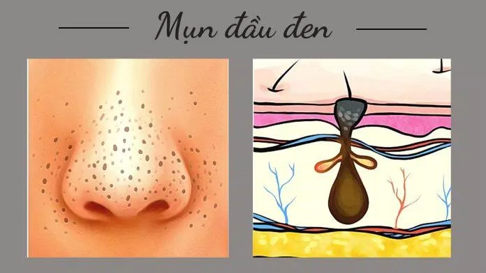 79 Các bước chăm sóc da mụn mà các Genz phải biết mới nhất 8 Mụn đầu đen thường thấy ở những vùng có lỗ chân lông to (Nguồn: Internet)