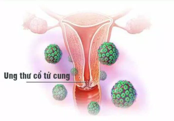 HPV có thể gây ra nhiều loại ung thư (Ảnh: Internet).