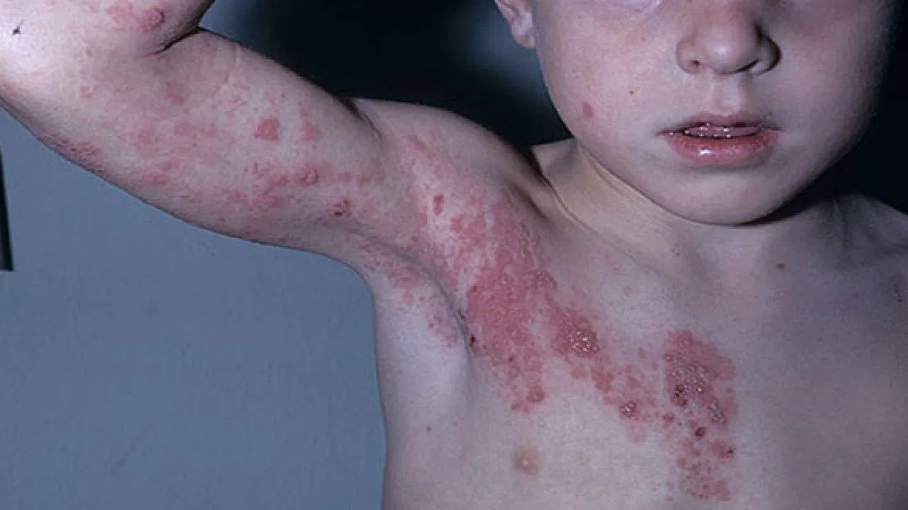 Đau ngực do zona thần kinh (Nguồn: Internet).