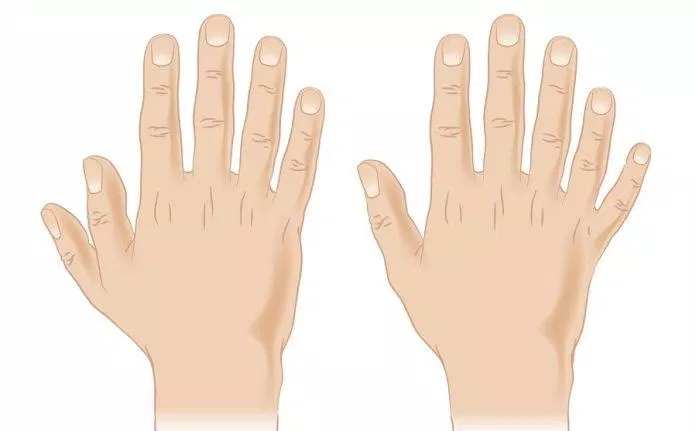 6 ngón tay là do gene trội đó nhé (Ảnh: Internet) 6 ngón tay là do gene trội đó nhé (Ảnh: Internet)