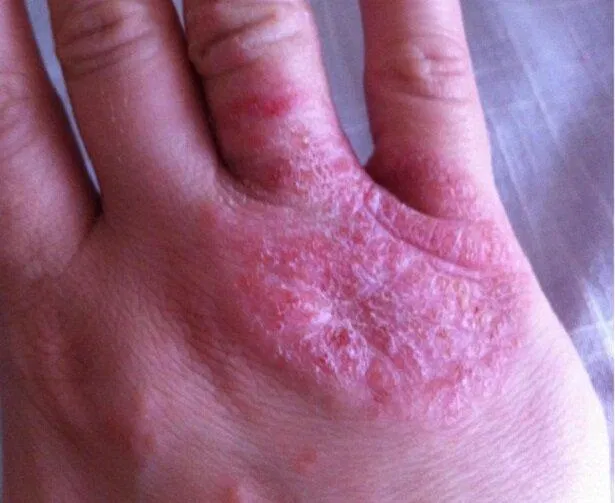 Chàm da ở bàn tay (Ảnh: Internet). Chàm da ở bàn tay (Ảnh: Internet).