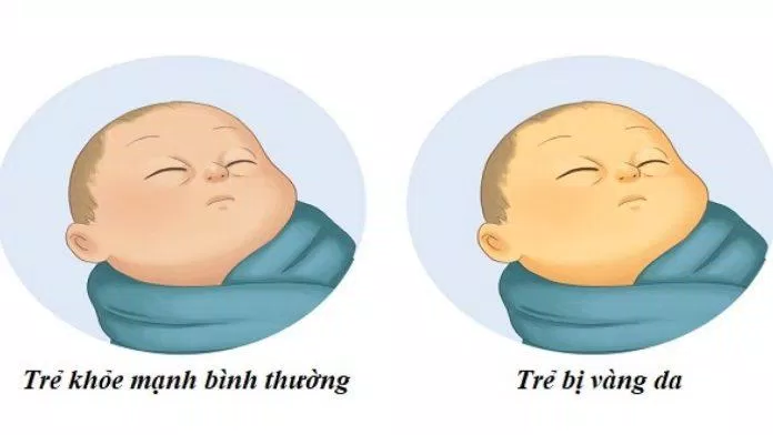 Khi cơ thể xuất hiện tình trạng vàng da bạn cần chăm sóc sức khỏe kỹ càng hơn (Ảnh: Internet). Khi cơ thể xuất hiện tình trạng vàng da bạn cần chăm sóc sức khỏe kỹ càng hơn (Ảnh: Internet).