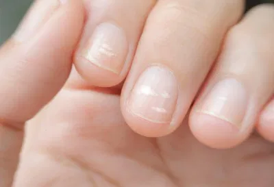 Xuất hiện các đốm trắng trên móng tay (Ảnh: Internet). Xuất hiện các đốm trắng trên móng tay (Ảnh: Internet).