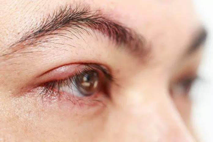 Lẹo mắt là một bệnh nhiễm trùng ở mắt (Ảnh: Internet).