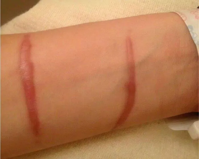 Cicatrices hypertrophiques (Source : Internet).