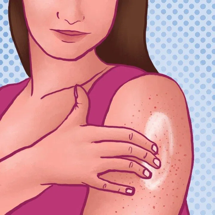 Keratosis pilaris cũng có thể liên quan đến yếu tố di truyền (Nguồn: Internet) Keratosis pilaris cũng có thể liên quan đến yếu tố di truyền (Nguồn: Internet)