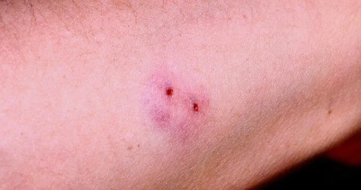 Vết thương do động vật cắn (Nguồn: Internet).