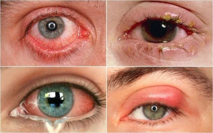 Đây là một trong những vấn đề nghiêm trọng nhất về mắt (Ảnh: Internet).