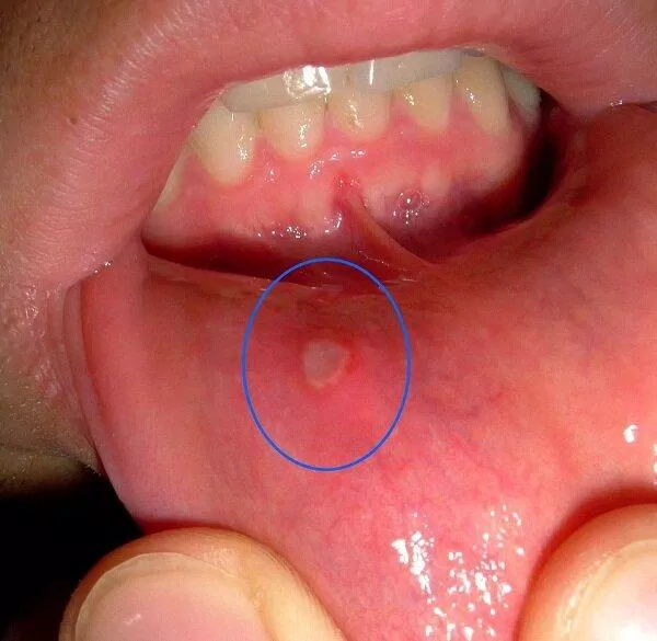 Viêm loét miệng có thể là dấu hiệu nguy hiểm (Nguồn: Internet)