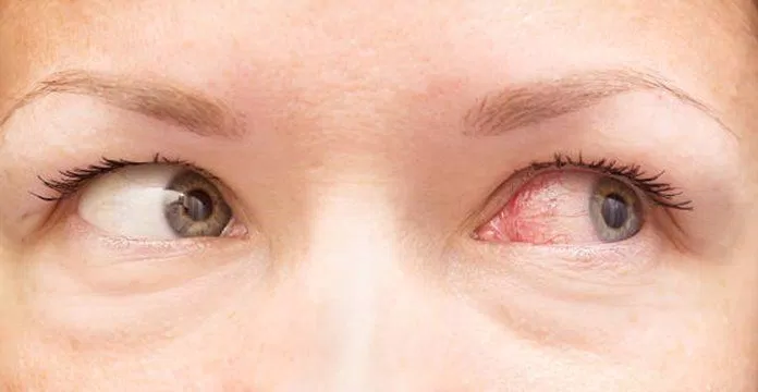 Khô mắt là một bệnh về mắt thường gặp (Ảnh: Internet).