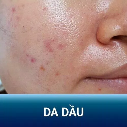 Da dầu mụn là da dầu có mụn (mụn trứng cá, mụn đầu đen, mụn bọc,...). Ảnh: Internet