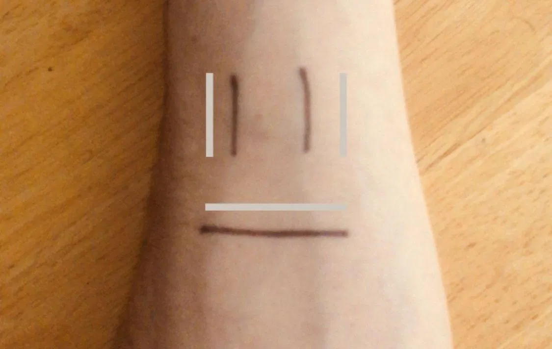 Vẽ ký hiệu đặc biệt lên vị trí cần xăm để ứng dụng nhận diện (Ảnh: Internet). Vẽ ký hiệu đặc biệt lên vị trí cần xăm để ứng dụng nhận diện (Ảnh: Internet).