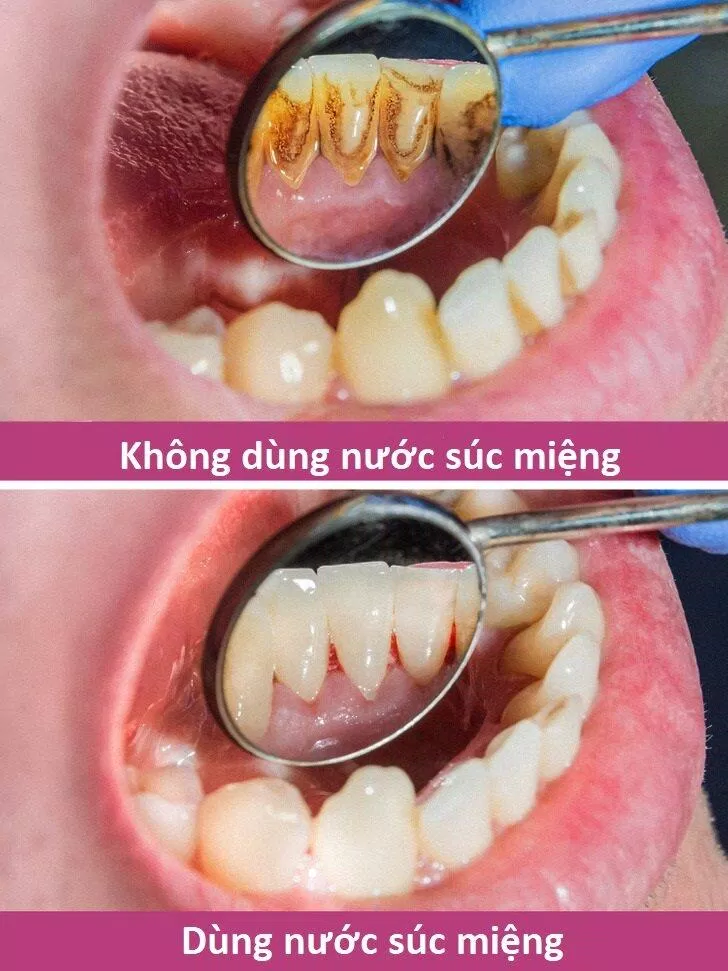 Nước súc miệng cũn giúp ích cho quá trình vệ sinh răng miệng (Ảnh: Internet) Nước súc miệng cũn giúp ích cho quá trình vệ sinh răng miệng (Ảnh: Internet)