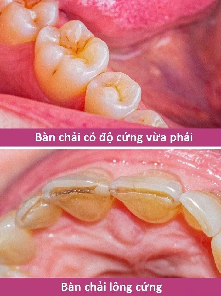 Bàn chải lông cứng gây hại cho răng nhiều hơn bạn tưởng (Ảnh: Internet) Bàn chải lông cứng gây hại cho răng nhiều hơn bạn tưởng (Ảnh: Internet)
