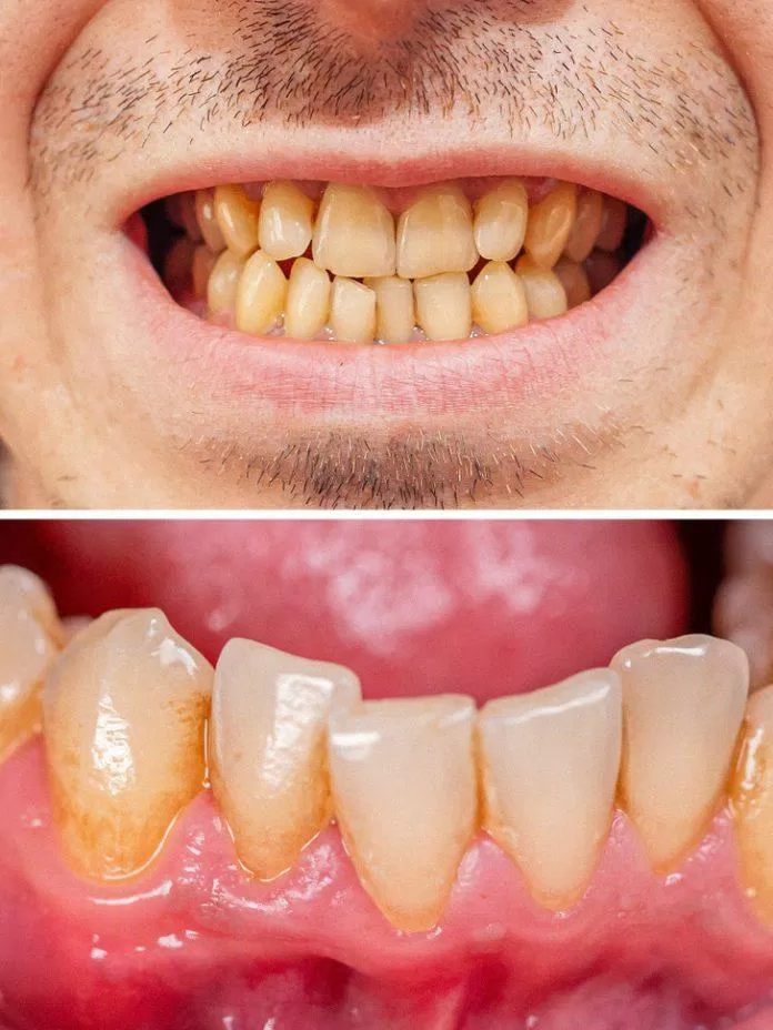 Đánh răng quá nhiều hoàn toàn không tốt cho răng (Ảnh: Internet)