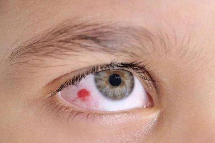 Vết máu ở mắt là do mạch máu nhỏ bị vỡ (Ảnh: Internet).