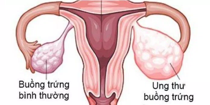 Bệnh ung thư buồng trứng ảnh hưởng đến khả năng sinh sản của phụ nữ (Nguồn: Internet)