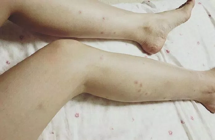 Đôi chân "hoa đốm" nhiều vết sẹo (Nguồn: Internet)