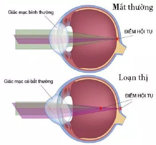 Mắt bình thường so với mắt loạn thị. (Ảnh: Internet) Mắt bình thường so với mắt loạn thị. (Ảnh: Internet)