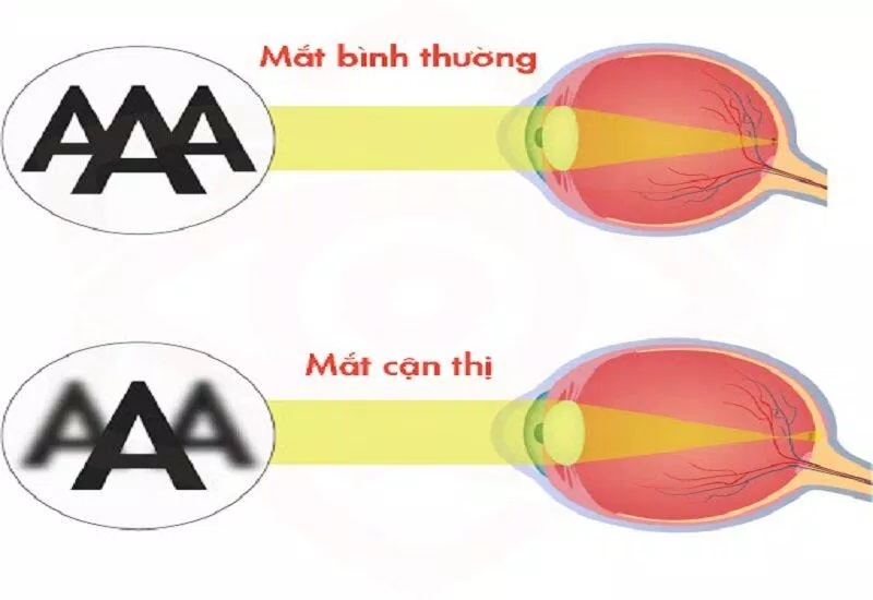 Mắt bình thường và mắt cận thị (Ảnh: Internet) Mắt bình thường và mắt cận thị (Ảnh: Internet)