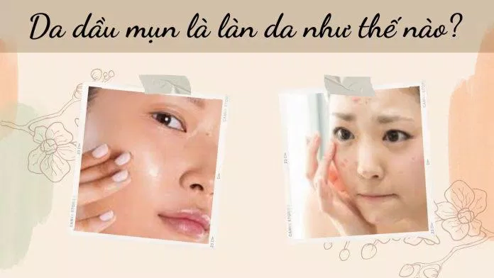 Da dầu mụn là làn da như thế nào? (Nguồn: Internet)