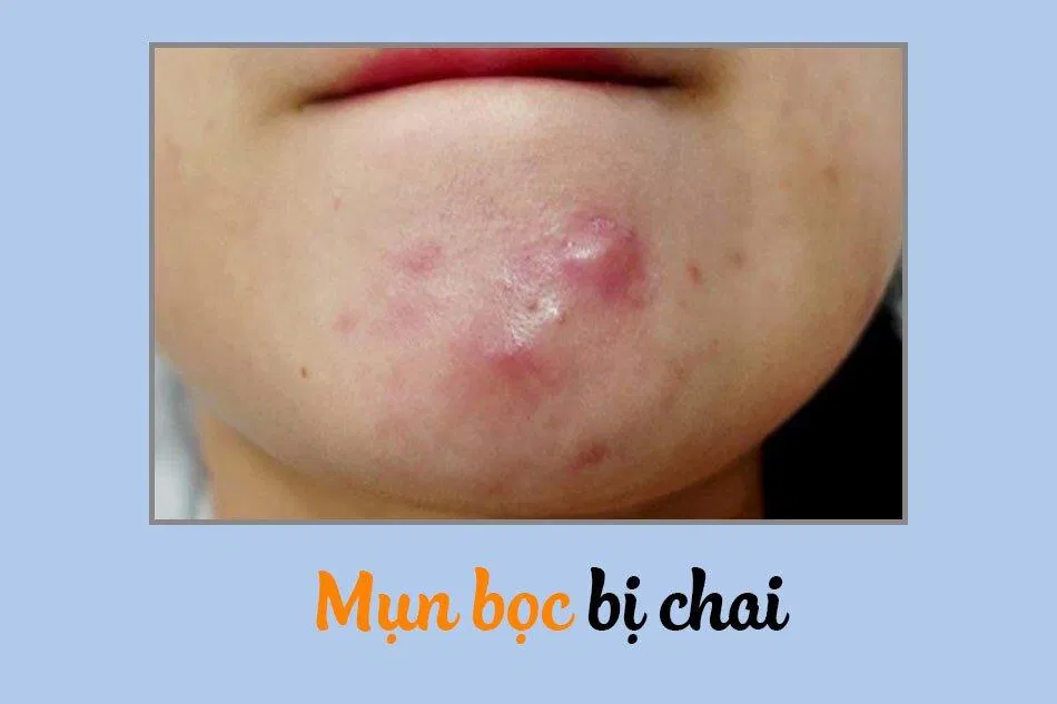 Mụn chai thường là biến thể của mụn bọc với nhiều kích cỡ khác nhau (Ảnh: internet)